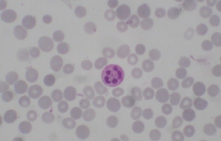 sindrome_constitucional_pancitopenia_b12/frotis_sangre_anemia_megaloblastica_pleocariocito sindrome_constitucional_pancitopenia_b12/frotis_sangre_anemia_megaloblastica_pleocariocito