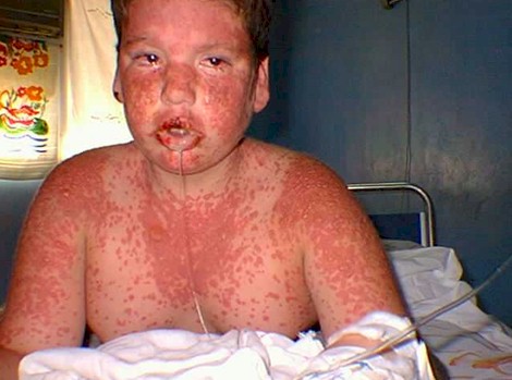 Sindrome_Stevens_Johnson/lesion_regiones_expuestas