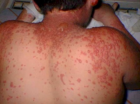Sindrome_Stevens_Johnson/lesiones_eritemato_papulo_bullosas Sindrome_Stevens_Johnson/lesiones_eritemato_papulo_bullosas