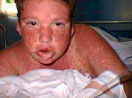 Sindrome_Stevens_Johnson/lesiones_eritemato_papulo_bulosas Sindrome_Stevens_Johnson/lesiones_eritemato_papulo_bulosas