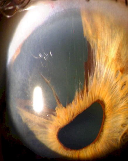 atrofia_esencial_iris/cornea_corneal