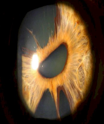 atrofia_esencial_iris/sindrome_endotelial_iridocorneal