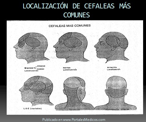 cefalalgia_cefalea/localizacion_dolor_de_cabeza