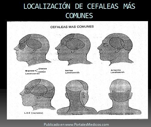 cefalalgia_cefalea/localizacion_dolor_de_cabeza