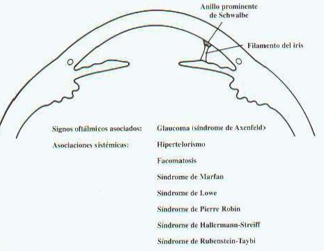 malformaciones_congenitas_cornea/anomalia_axenfeld