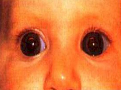 malformaciones_congenitas_cornea/megalocornea_bilateral_infancia