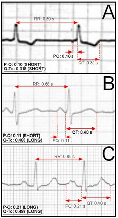 diversidad_sistole_electrica/ECG_QT_RR_PQ_intervalo