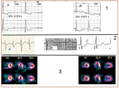 diversidad_sistole_electrica/EKG_RR_QT_intervalo