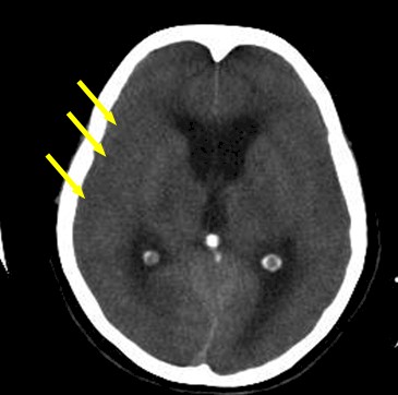 enfermedad_cerebrovascular_isquemica/TAC_borramiento_surcos_corticales