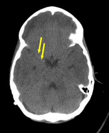 enfermedad_cerebrovascular_isquemica/TAC_hiperdensidad_cerebral_media