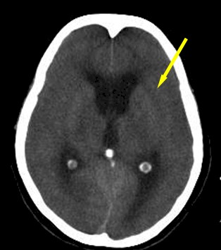 enfermedad_cerebrovascular_isquemica/TAC_hipodensidad_nucleo_lenticular