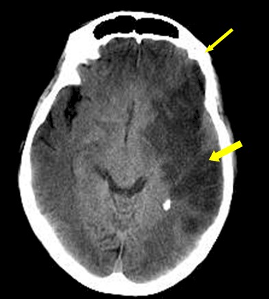 Infarto Cerebral