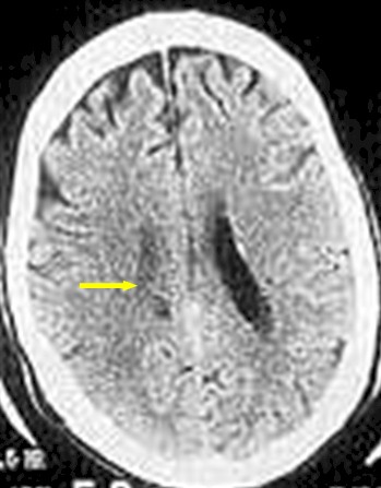 enfermedad_cerebrovascular_isquemica/TAC_perdida_sustancia_gris