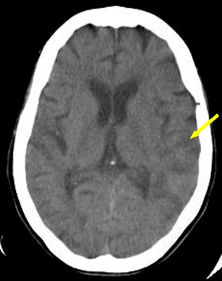 enfermedad_cerebrovascular_isquemica/TAC_signo_cinta_cortical_insular