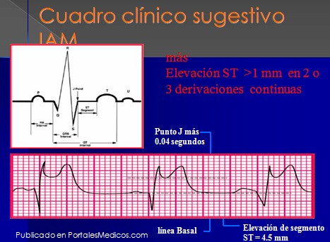 infarto_agudo_miocardio/IAM_ECG_electrocardiograma