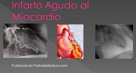 infarto_agudo_miocardio/IAM_IMA_imagenes
