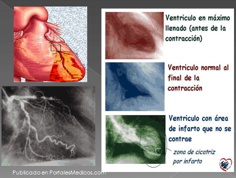 infarto_agudo_miocardio/coronariografia_ventriculografia infarto_agudo_miocardio/coronariografia_ventriculografia
