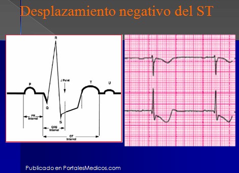 infarto_agudo_miocardio/desplazamiento_negativo_ST