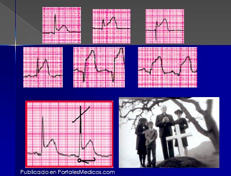 infarto_agudo_miocardio/isquemia_cambios_electricos