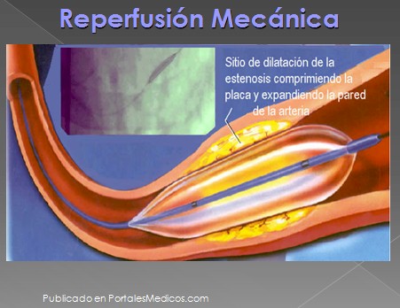 infarto_agudo_miocardio/reperfusion_mecanica