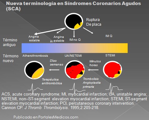 infarto_agudo_miocardio/terminologia_sindrome_coronario_agudo