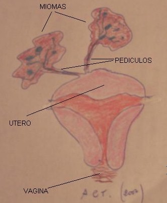 mioma_infartado/esquema_pediculacion_torsion mioma_infartado/esquema_pediculacion_torsion