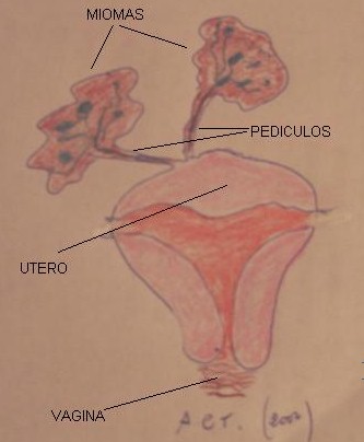 mioma_infartado/esquema_pediculacion_torsion