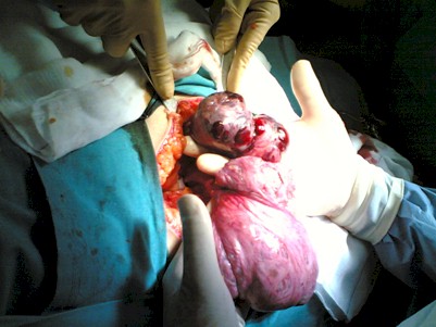 mioma_infartado/extirpacion_reseccion_tumoracion mioma_infartado/extirpacion_reseccion_tumoracion