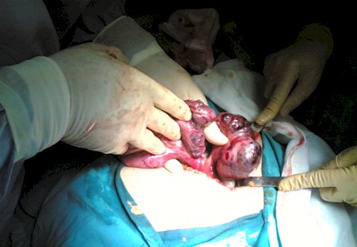mioma_infartado/miomectomia_resecado mioma_infartado/miomectomia_resecado