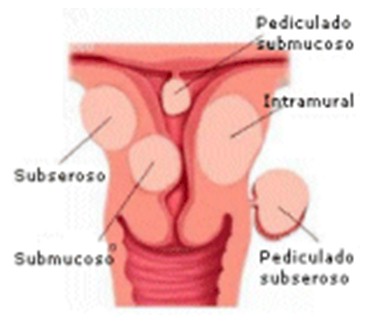 mioma_infartado/situacion_posicion_localizacion_mioma