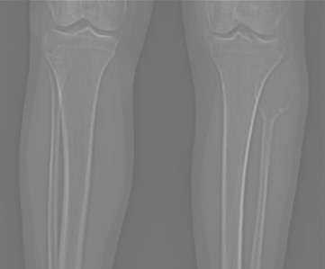 tumor_oseo_celulas_gigantes/TAC_anteroposterior_tumoracion tumor_oseo_celulas_gigantes/TAC_anteroposterior_tumoracion