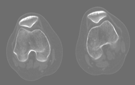 tumor_oseo_celulas_gigantes/perone_TAC_tumoracion tumor_oseo_celulas_gigantes/perone_TAC_tumoracion