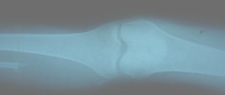 tumor_oseo_celulas_gigantes/perone_radiografia_cirugia