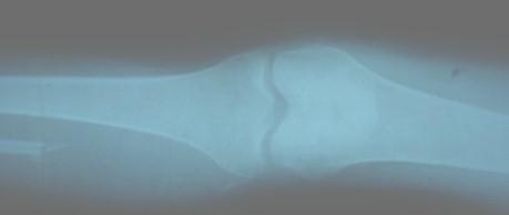 tumor_oseo_celulas_gigantes/perone_radiografia_cirugia tumor_oseo_celulas_gigantes/perone_radiografia_cirugia