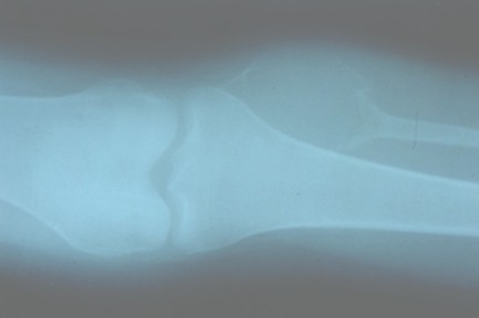 tumor_oseo_celulas_gigantes/perone_radiografia_tumoracion tumor_oseo_celulas_gigantes/perone_radiografia_tumoracion