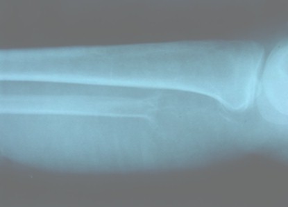 tumor_oseo_celulas_gigantes/perone_radiologia_tumoracion tumor_oseo_celulas_gigantes/perone_radiologia_tumoracion