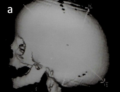 escafocefalia_tecnicas_quirurgicas/escaner_cerebral_reconstruccion_3D escafocefalia_tecnicas_quirurgicas/escaner_cerebral_reconstruccion_3D