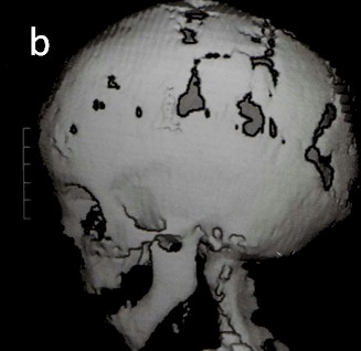 escafocefalia_tecnicas_quirurgicas/scaner_cerebral_reconstruccion_3D