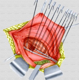 hernias_inguinales/cierre_fascia_inguinal