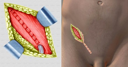 hernias_inguinales/cierre_herniorrafia