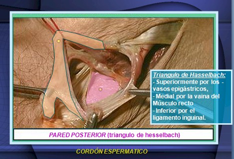 hernias_inguinales/cordon_espermatico