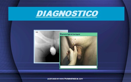 hernias_inguinales/diagnostico_hernia_inguinal