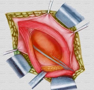 hernias_inguinales/diseccion_tejidos_hernia