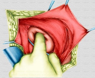 hernias_inguinales/exploracion_saco_herniario