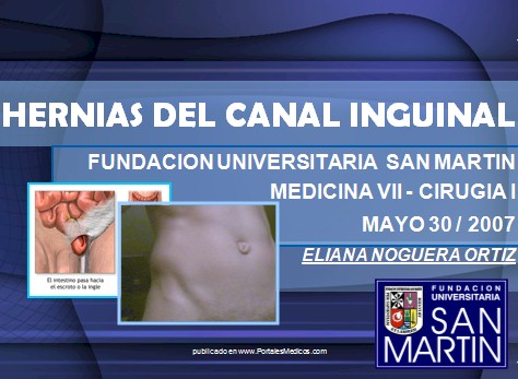 hernias_inguinales/hernia_canal_inguinal