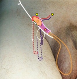 hernias_inguinales/hernia_inguinal_indirecta hernias_inguinales/hernia_inguinal_indirecta