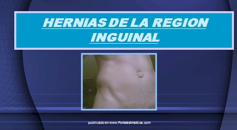 hernias_inguinales/hernia_region_inguinal