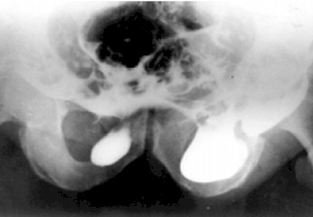 hernias_inguinales/herniografia_hernia_bilateral