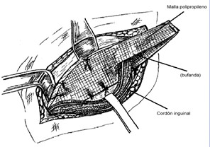 hernias_inguinales/herniorrafia_de_lichtenstein