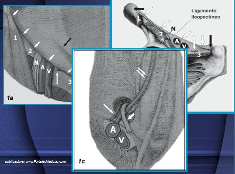 hernias_inguinales/ligamento_ileopectineo